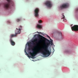 Acanthamoeba_HE_Vish4.jpg Figure D: Cyst of <em>Acanthamoeba</em> sp. from brain tissue, stained with hematoxylin and eosin (H&E).