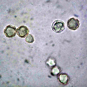Acanthamoeba_cysts_culture_Vish2.jpg Figure B: Cysts of <em>Acanthamoeba</em> spp. in culture.