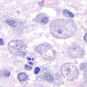 Acanthamoeba.jpg Figure D: Trophozoites of <em>Acanthamoeba</em> sp. in a corneal scraping, stained with H&E.