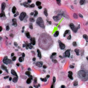 Acanthamoeba_HE_Vish1_1000x.jpg Figure C: Trophozoite of <em>Acanthamoeba</em> sp. in tissue, stained with hematoxylin and eosin (H&E).