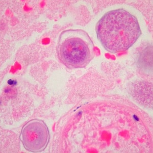B_mandrillaris_Cook1.jpg Figure H: Cysts of <em>B. mandrillaris</em> in brain tissue, stained with H&E. Image courtesy of Cook Children’s Hospital, Fort Worth, Texas.