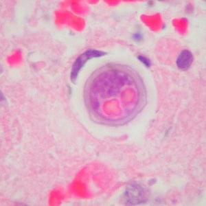 B_mandrillaris_Cook2.jpg Figure I: Cyst of <em>B. mandrillaris</em> in brain tissue, stained with H&E. Image courtesy of Cook Children’s Hospital, Fort Worth, Texas.