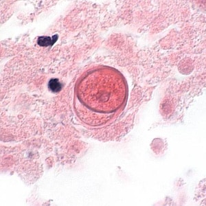 B_mandrillaris_UKY1.jpg Figure F: Cyst of <em>B. mandrillaris</em> in brain tissue, stained with H&E. Image courtesy of the University of Kentucky Hospital, Lexington, Kentucky.