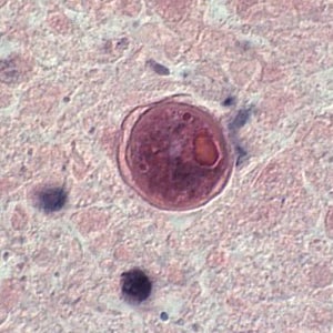 B_mandrillaris_UKY2.jpg Figure G: Cyst of <em>B. mandrillaris</em> in brain tissue, stained with H&E. Image courtesy of the University of Kentucky Hospital, Lexington, Kentucky.