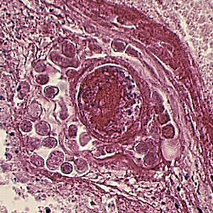 Balamuthia_cyst_HE_Vish1.jpg Figure D: Cyst of <em>B. mandrillaris</em> in brain tissue, stained with hematoxylin and eosin (H&E).