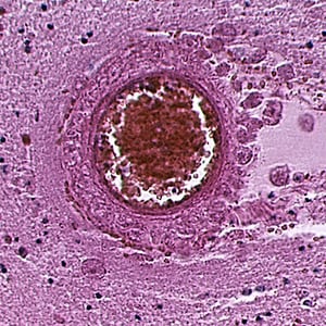 Balamuthia_cyst_HE_Vish2.jpg Figure E: Cyst of <em>B. mandrillaris</em> in brain tissue, stained with hematoxylin and eosin (H&E).