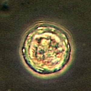 Balamuthia_cyst_Vish2.jpg Figure B: Close-up of one of the cysts in Figure A.