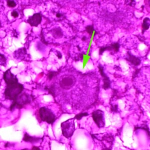 Balamuthia_troph_HE_Vish1.jpg Figure F: A single trophozoite (green arrow) of <em>B. mandrillaris</em> in brain tissue, stained with H&E.