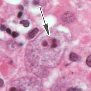 Balamuthia_troph_HE_Vish2.jpg Figure G: A single trophozoite (black arrow) of <em>B. mandrillaris</em> in brain tissue, stained with H&E.
