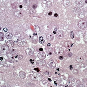 Balamuthia_troph_HE_Vish3.jpg Figure E: Several trophozoites of <em>B. mandrillaris</em> in brain tissue, stained with hematoxylin and eosin (H&E).