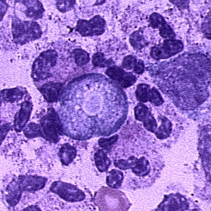 N_fowleri_CSF_Vish1.jpg Figure D: Trophozoite of <em>N. fowleri</em> in CSF, stained with hematoxylin and eosin (H&E).