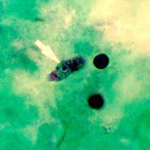 N_fowleri_troph_TX.jpg Figure E: Trophozoite of <em>N. fowleri</em> in CSF, stained with trichrome. Image courtesy of the Texas State Health Department.