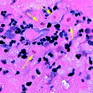 Sappinia_brain_Vish1.jpg Figure F: Four trophozoites (yellow arrows) of <em>S. pedata</em> in brain tissue, stained with hematoxylin and eosin (H&E). In three of the amebae, the two nuclei can easily be seen.
