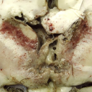 Brain_pathology_Cook1.jpg Figure B: Gross specimen of brain tissue from a patient who died of granulomatous amebic encephalitis (GAE) caused by <em>Balamuthia mandrillaris</em>. The autopsy specimen revealed extensive necrotizing (mixed inflammatory, occasional giant cells, vasculitic) granulomatous encephalitis with a subependymal necroinflammatory process. Image courtesy of Cook Children’s Hospital, Fort Worth, Texas.