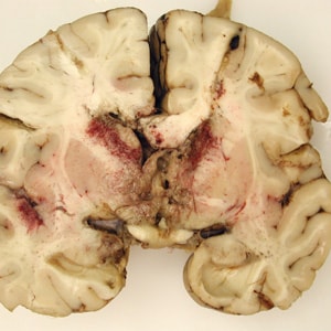 Brain_pathology_Cook2.jpg Figure A: Gross specimen of brain tissue from a patient who died of granulomatous amebic encephalitis (GAE) caused by <em>Balamuthia mandrillaris</em>. The autopsy specimen revealed extensive necrotizing (mixed inflammatory, occasional giant cells, vasculitic) granulomatous encephalitis with a subependymal necroinflammatory process. Image courtesy of Cook Children’s Hospital, Fort Worth, Texas.