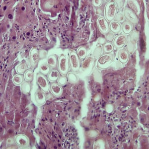 C_hepatica_eggs_200x_HB.jpg Figure A: Eggs of <em>C. hepatica</em> in liver stained with hematoxylin and eosin (H&E).