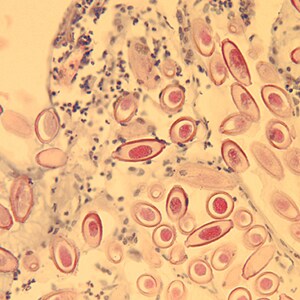 Figure D: Eggs of C. hepatica in liver stained with H&E. Figure D: Eggs of <em>C. hepatica</em> in liver stained with H&E.