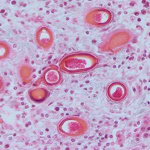 C_hepatica_tissue_HB.jpg Figure C: Eggs of <em>C. hepatica</em> in liver stained with H&E.