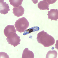 A 75-year-old man had gastrointestinal bleeding while in Nigeria and received 8 units of whole blood that was reportedly imported from India. After his return to the United States two months later, he experienced fever (101º) and chills. 