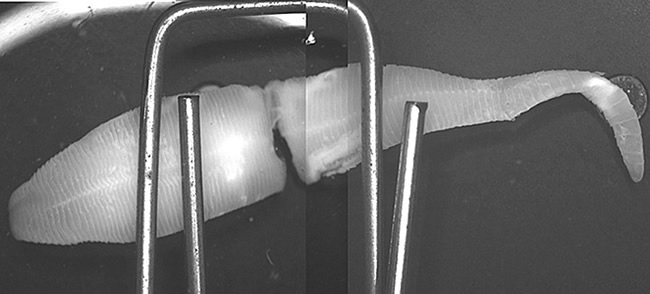 A live worm was recovered from a 3-year-old's diaper. The child was healthy and had not traveled outside of the country. 