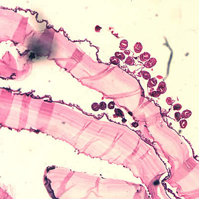 February - 2005 - Case #150 A 28-year-old previously healthy man had a physical examination, including a chest x-ray, as one of his pre-employment requirements. The man had emigrated from Bulgaria approximately one year prior to the examination.