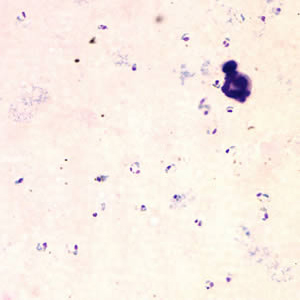 April - 2005 - Case #153 A 32-year-old male from Nigeria had been visiting some relatives in the United States for approximately a week. He went to a local emergency room for headaches, nausea, and general weakness and fatigue.