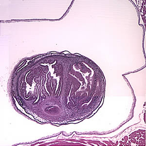 A 49-year-old male immigrant from Mexico was seen at a local medical facility specializing in neural disorders for frequent headaches and occasional seizures. 