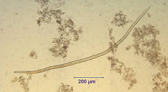 May - 2005 - Case #155 An 8-year-old boy complained of bloating and intermittent diarrhea, and he told his mother he had passed a worm when he went to the bathroom.