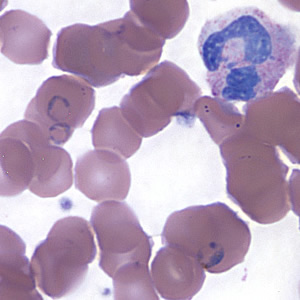 A 25-year-old woman with symptoms of intermittent fever, nausea, and headaches went to the emergency room with a temperature of 104º. She had worked and traveled in West Africa for the previous five months.