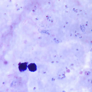 A 61-year-old New England resident was visiting his relatives in Georgia for the summer. He had recurring fevers and general weakness and at night he often experienced gastrointestinal discomfort.