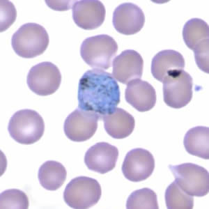 October - 2005 - Case #165 A woman went to a local emergency room due to fevers and chills. She reported that she had traveled abroad to Burma and Thailand recently for three weeks. When she traveled abroad previously, she had taken malaria prophylaxis that she received from a travel clinic, but she had not returned to the clinic before her most recent trip.