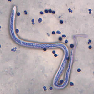 In April 2005, DPDx telediagnosis inquiries received a request for assistance from the Oregon State Public Health Laboratory. Images from a thick and thin blood smear were submitted. Based on information that came with the specimen, the smears were most likely stained with Giemsa.