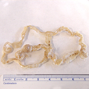 January - 2006 - Case #172 A 45-year-old female noticed a long, worm-like object in her stool. The object was collected and, along with tissue sections prepared by the hospital where she was seen, submitted to the Florida public health laboratory for examination.