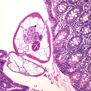 A teenager underwent surgery for a traumatic injury to his abdominal cavity. Apart from the injury, the surgeon noticed some necrosis around the youth's appendix. 
