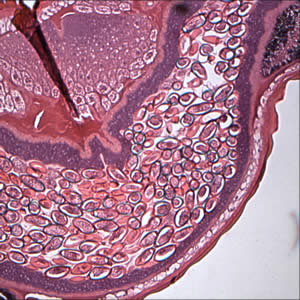 March - 2006 - Case #175 An elderly patient underwent a colonoscopy for polyps. A worm was seen near the appendiceal orifice and a biopsy was taken, fixed in formalin, and sent to histology.