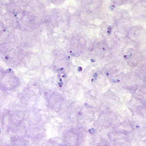 A 43-year-old man went to his physician complaining of fatigue. The man reported that he hiked and camped a lot throughout the northeastern United States weeks before the symptoms started. 