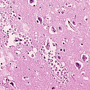 June - 2006 - Case #181 A patient was admitted to a hospital with a one-day history of fever and persistent headache on the right side. Approximately 10 days prior to the onset of symptoms, the individual swam in a small swimming hole, associated with a river.