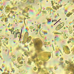 A man went to a local hospital with abdominal pain and weight loss. He reported that he frequently travels to South America and had previously been diagnosed with ascariasis, although recent stool specimens were negative. 