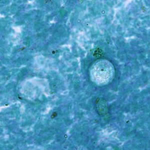 A 35-year-old man was seen by a physician for diarrhea and abdominal pain. An ova and parasites (O & P) examination was ordered, along with other tests. 