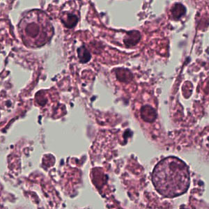 A request for confirmation of an identification was submitted to DPDx Telediagnosis Assistance. Figures A and B were captured from a hematoxylin and eosin (H & E) stained histological section of a liver abscess found during an autopsy. 