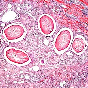 A 45-year-old woman had a nodule approximately 1 cm in diameter located near a scar from a previous mastectomy. The patient had traveled to several western and central European countries within the past year. 