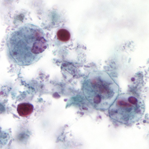 December - 2006 - Case #194 Images from a trichrome stained fecal smear were submitted to DPDx telediagnosis assistance from a public health laboratory. Parasites were suspected and further confirmation was needed. The patient was a 32-year-old male who had diarrhea; no travel history was known.