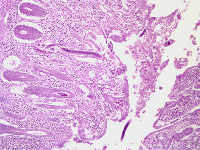 A 49-year-old Filipino man had an intestinal tissue biopsy taken. Figures A-C show what was seen on slides stained with hematoxylin and eosin (H & E). 