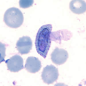 April - 2007 - Case #202 A patient was seen at a hospital in Rwanda with headache, fever, and chills. A thin blood smear was made, stained with Giemsa, and examined.
