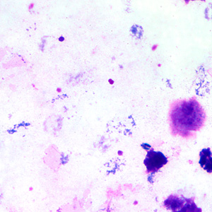 Giemsa-stained thick and thin blood smears were examined as part of a screening protocol for refugees from a country that has areas of ongoing malaria transmission. 