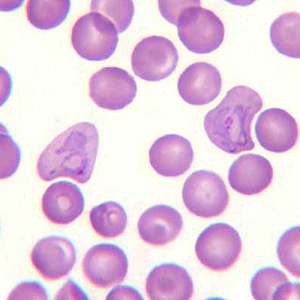 June - 2007 - Case #205 A 30-year-old man from Sudan had fever and chills. He was also mildly jaundiced. He went to his physician who ordered a blood smear examination.