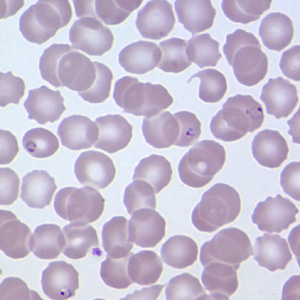 A 54-year-old Haitian man was admitted to a hospital emergency room with back pain and fever. Blood was collected, and slides were made and stained with Giemsa. 
