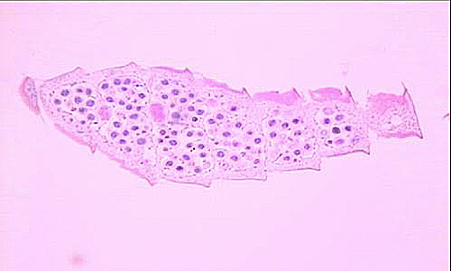 A 49-year-old man, with no known travel history, had a colonoscopy. His physician observed small worms during the procedure that were 3 to 4 mm in length. 