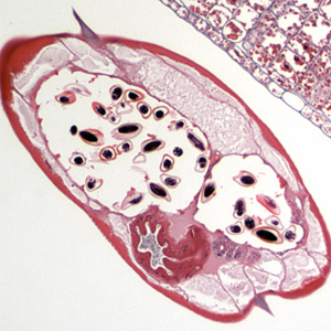 A 49-year-old man, with no known travel history, had a colonoscopy. His physician observed small worms during the procedure that were 3 to 4 mm in length. 