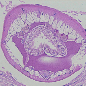 November - 2007 - Case #215 A 33-year-old Lithuanian woman had swellings in various regions of her body that developed over the last two years. She reported that she worked as a cook, and she also stated she had traveled to Kazakhstan three years ago.